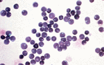Cerebrospinal fluid of an ALL patient