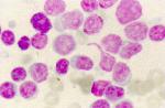 Image of cells from an L1 case of ALL