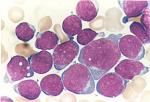 Image of cells from an L2 case of ALL