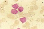Image of cells from an L2 case of ALL