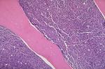 Medium-power microscope image of ALL marrow
